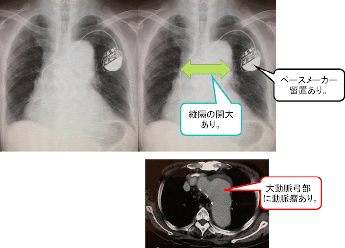 画像あり】胸部レントゲンの所見で異常所見あり！？どんな病気が考え 